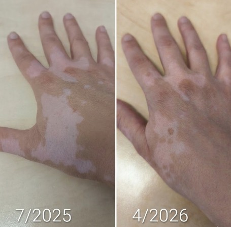 Vitiligo on hands treatment