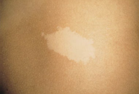 nevus