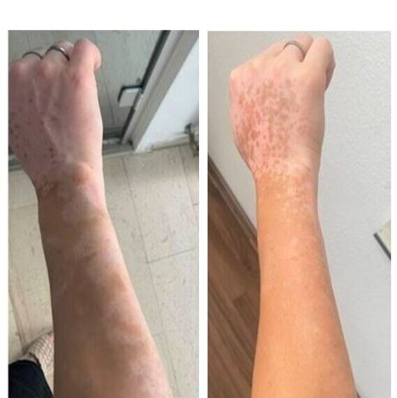 Vitiligo repigmentation