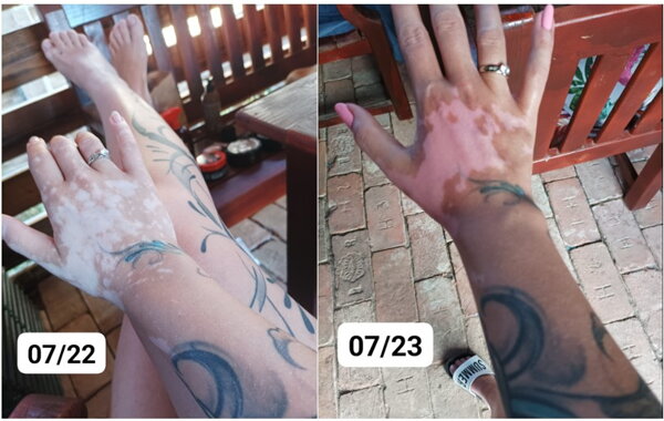 Vitiligo repigmentation